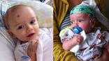 When newborn baby boy Finnegan was diagnosed with epilepsy, his parents were reluctant to consider brain surgery. But after their son started having  seizures a day, they agreed, and their sonwould receive a brand new type of brain operation – one that had never before been performed in the United States.